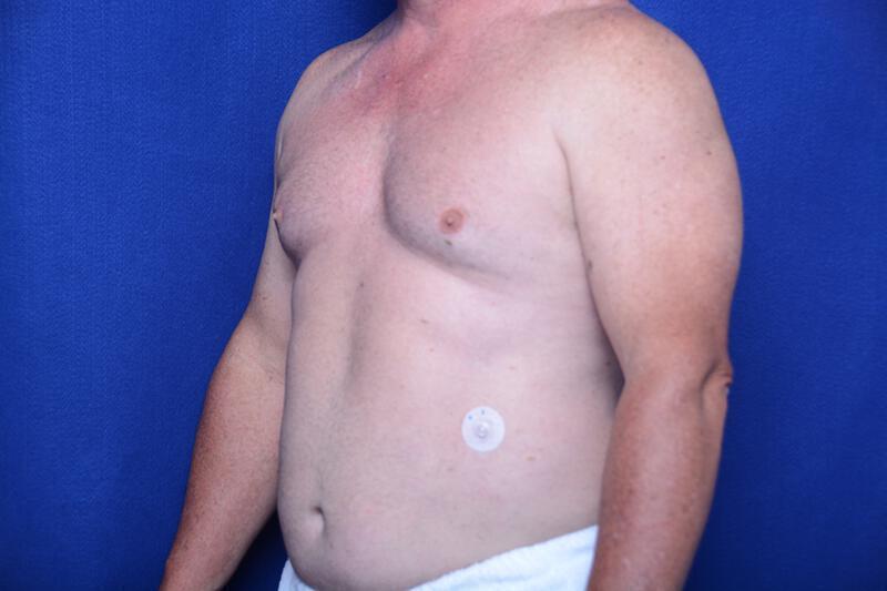 Gynecomastia Gallery Before & After Image