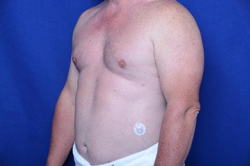 Gynecomastia Gallery Before & After Image