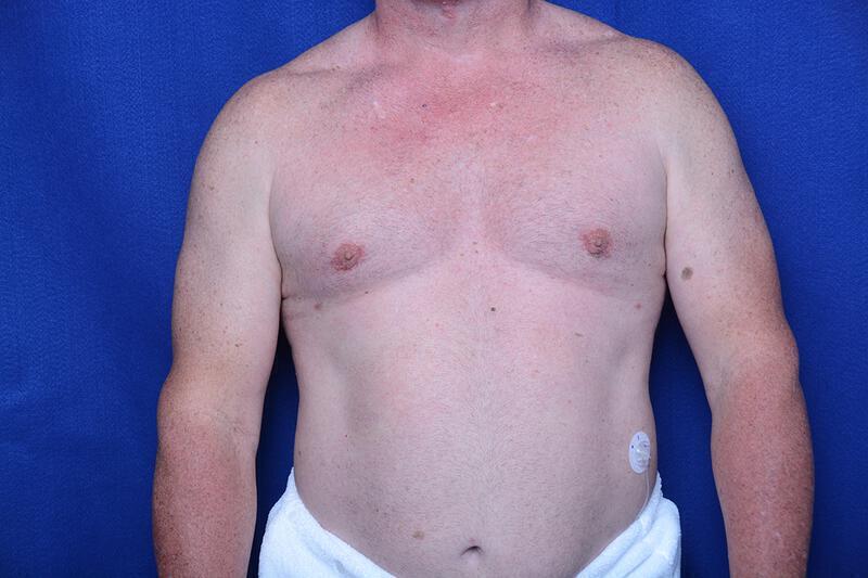 Gynecomastia Gallery Before & After Image