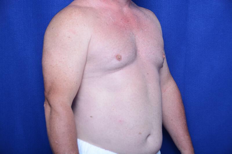 Gynecomastia Gallery Before & After Image