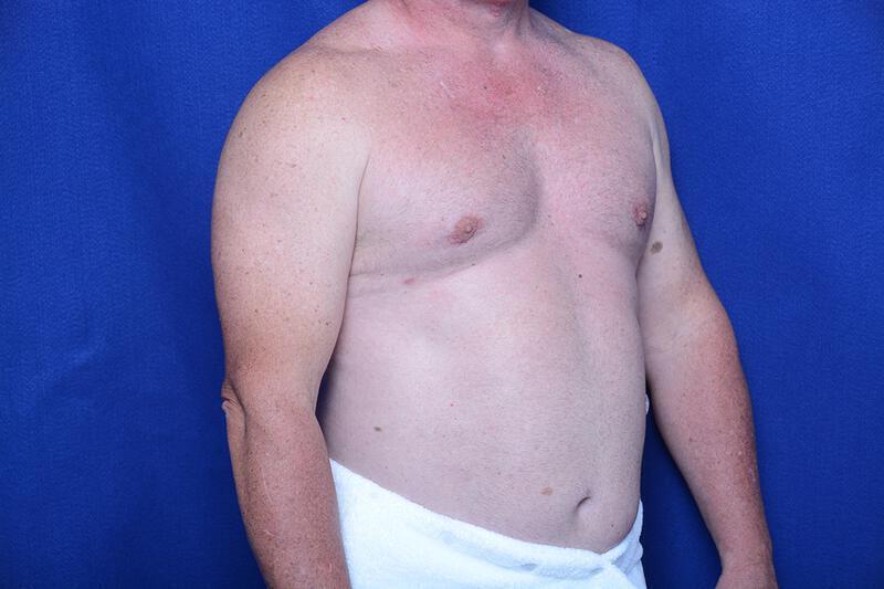 Gynecomastia Gallery Before & After Image