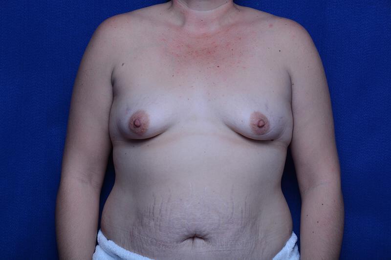 Tuberous Breast Gallery Before & After Image