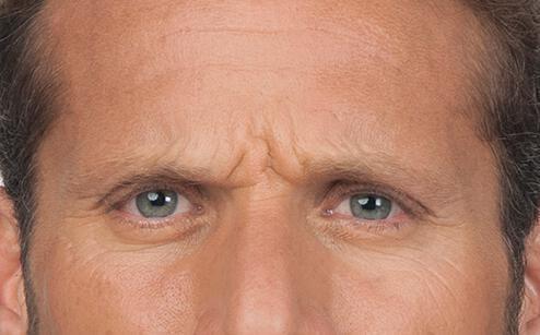 BOTOX® for men Gallery Before & After Image