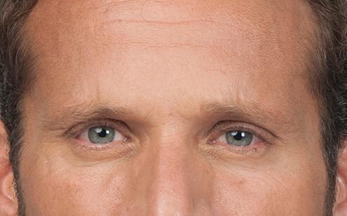 BOTOX® for men Gallery Before & After Image