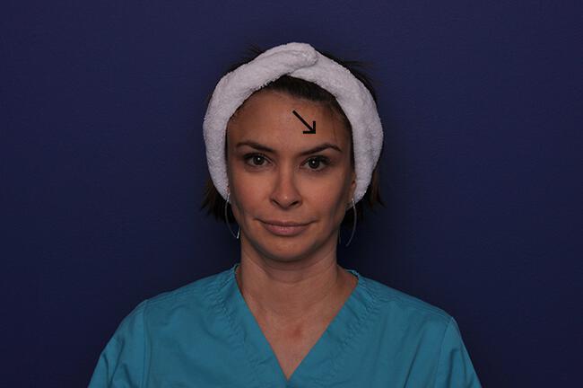 Botox Gallery Before & After Image