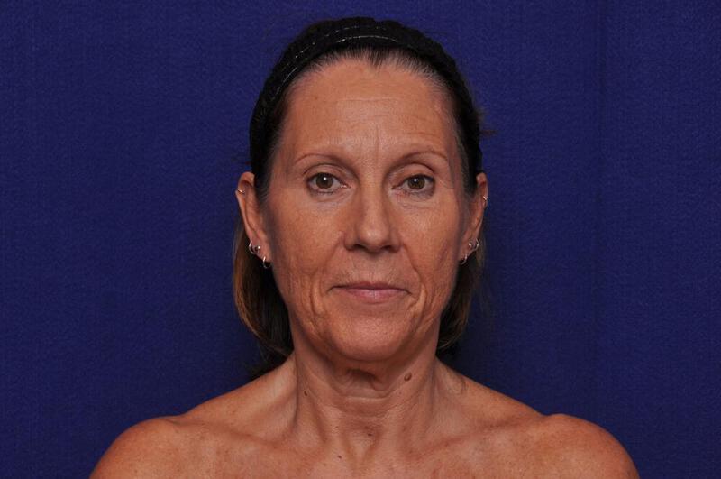 Fractional Laser Gallery Before & After Image