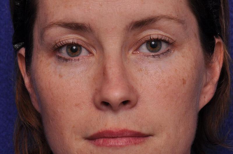 Injectable Cheek Lift Gallery Before & After Image