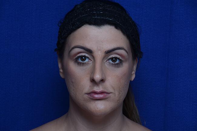 Injectable Cheek Lift Gallery Before & After Image