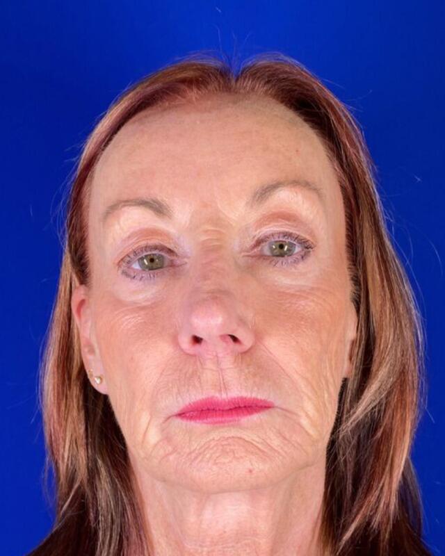 Injectable Cheek Lift Gallery Before & After Image