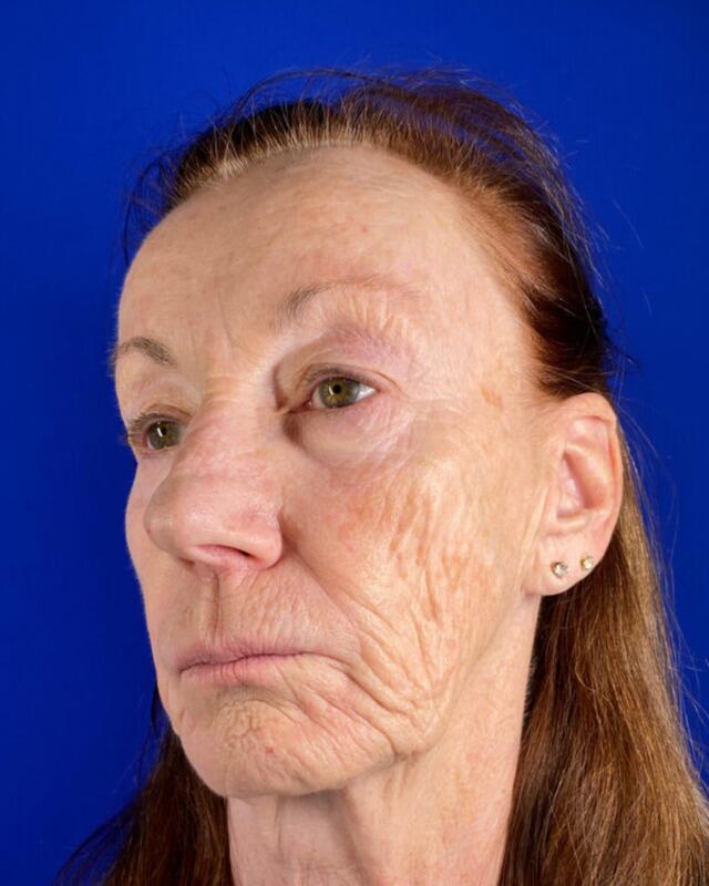 Injectable Cheek Lift Gallery Before & After Image