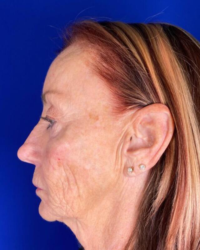 Injectable Cheek Lift Gallery Before & After Image