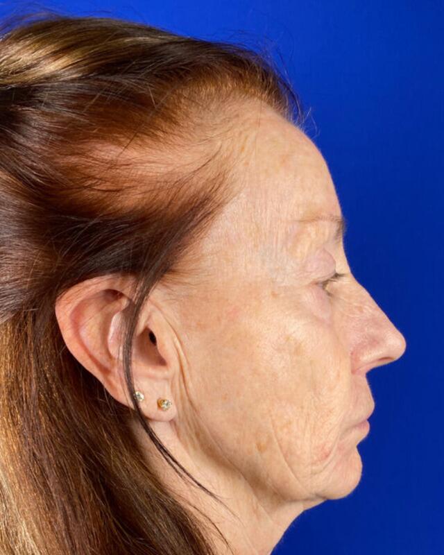 Injectable Cheek Lift Gallery Before & After Image