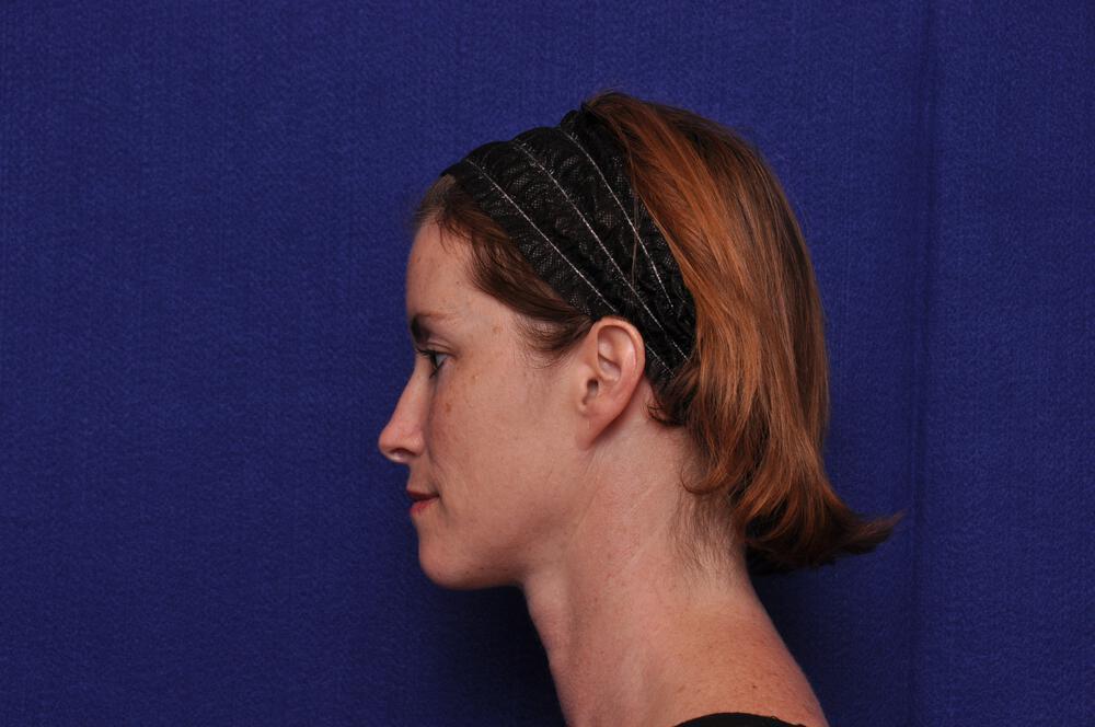Liquid Facelift Gallery Before & After Image