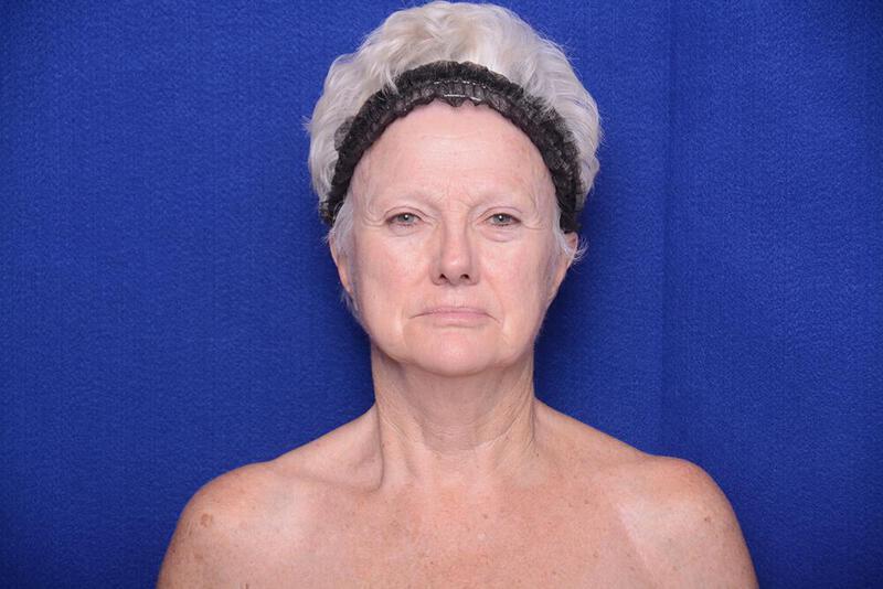 Lower Blepharoplasty Gallery Before & After Image