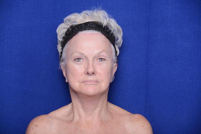 Lower Blepharoplasty Gallery Before & After Image