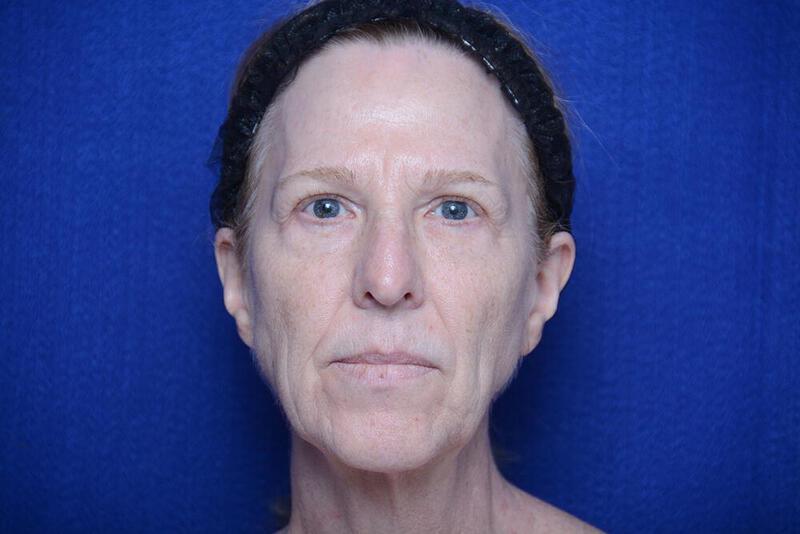 Lower Blepharoplasty Gallery Before & After Image