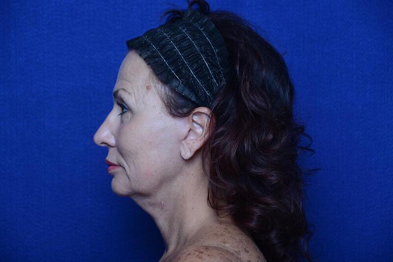 Lower Blepharoplasty Gallery Before & After Image