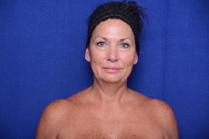 Lower Blepharoplasty Gallery Before & After Image