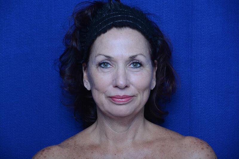 Lower Blepharoplasty Gallery Before & After Image