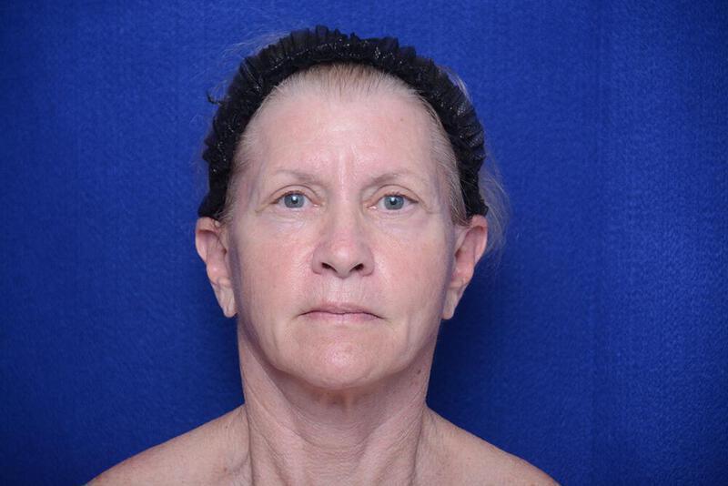 Lower Blepharoplasty Gallery Before & After Image