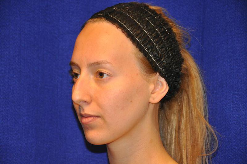 Rhinoplasty Gallery Before & After Image