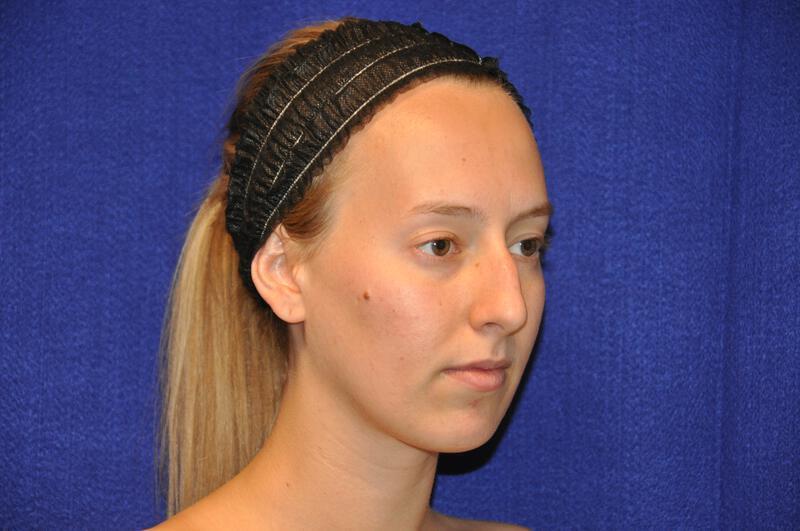 Rhinoplasty Gallery Before & After Image