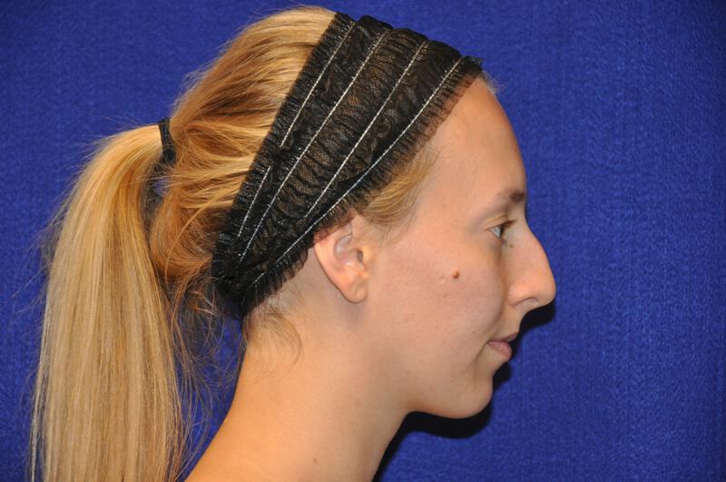 Rhinoplasty Gallery Before & After Image