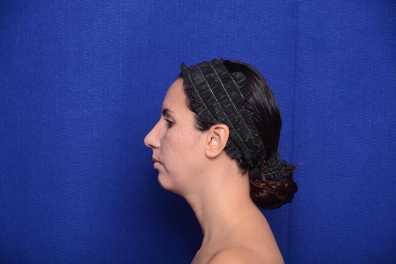 Rhinoplasty Gallery Before & After Image