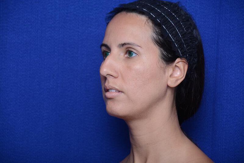 Rhinoplasty Gallery Before & After Image