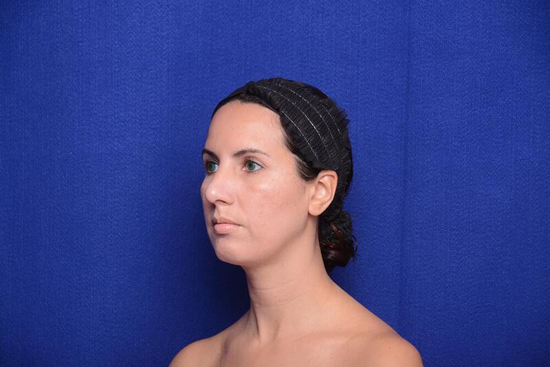 Rhinoplasty Gallery Before & After Image