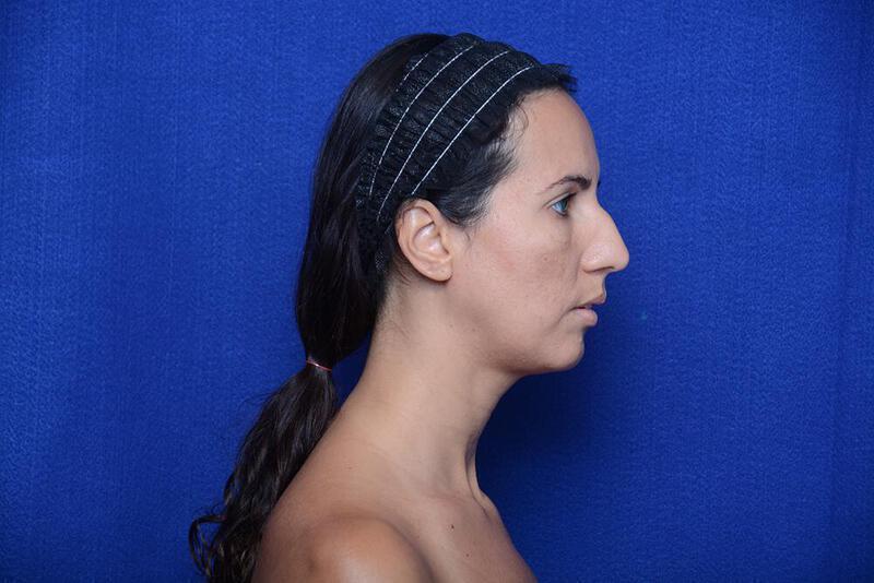 Rhinoplasty Gallery Before & After Image