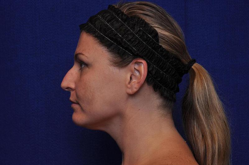 Rhinoplasty Gallery Before & After Image