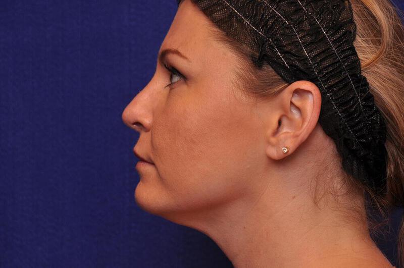 Rhinoplasty Gallery Before & After Image