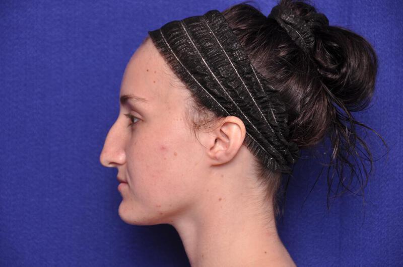 Rhinoplasty Gallery Before & After Image