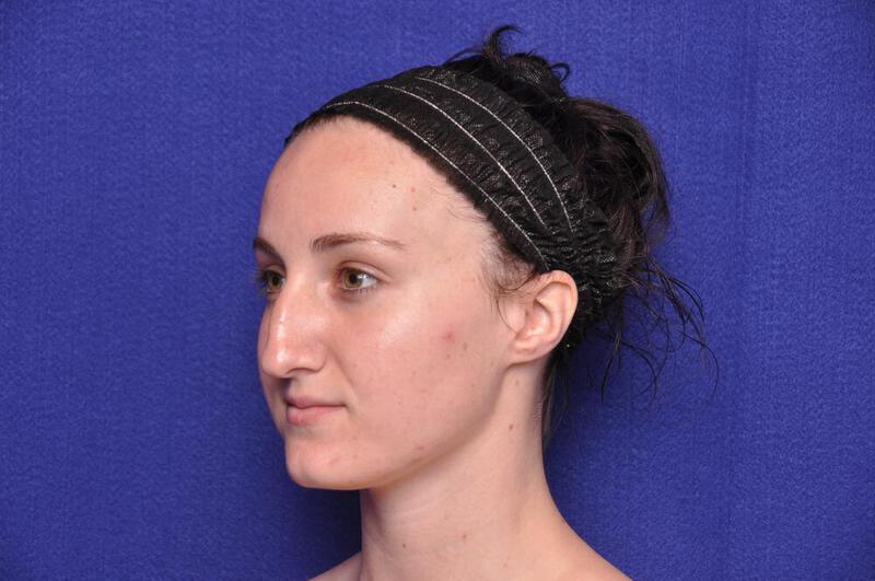 Rhinoplasty Gallery Before & After Image