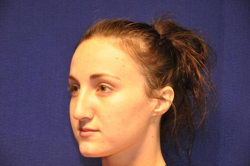 Rhinoplasty Gallery Before & After Image