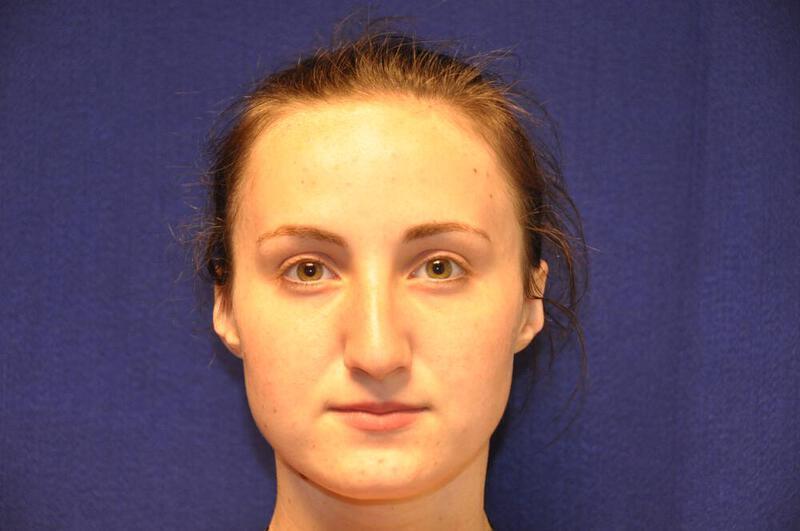 Rhinoplasty Gallery Before & After Image