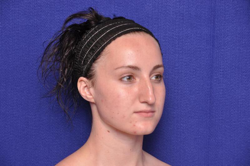 Rhinoplasty Gallery Before & After Image