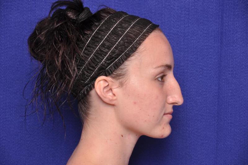 Rhinoplasty Gallery Before & After Image