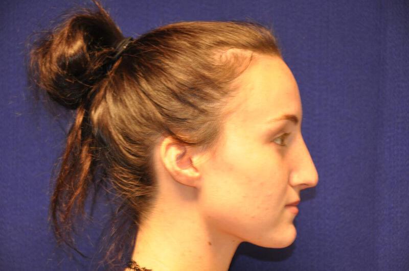 Rhinoplasty Gallery Before & After Image