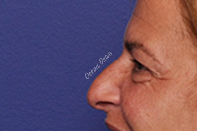 Rhinoplasty Gallery Before & After Image