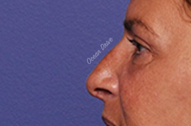 Rhinoplasty Gallery Before & After Image