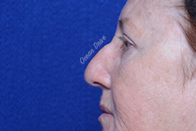 Rhinoplasty Gallery Before & After Image