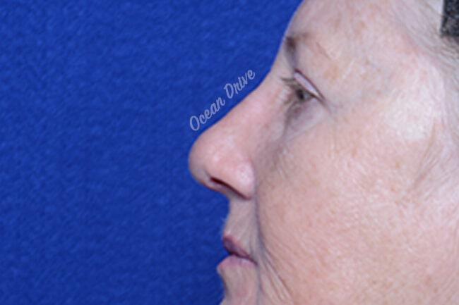 Rhinoplasty Gallery Before & After Image