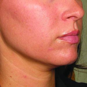 Ultherapy Gallery Before & After Image