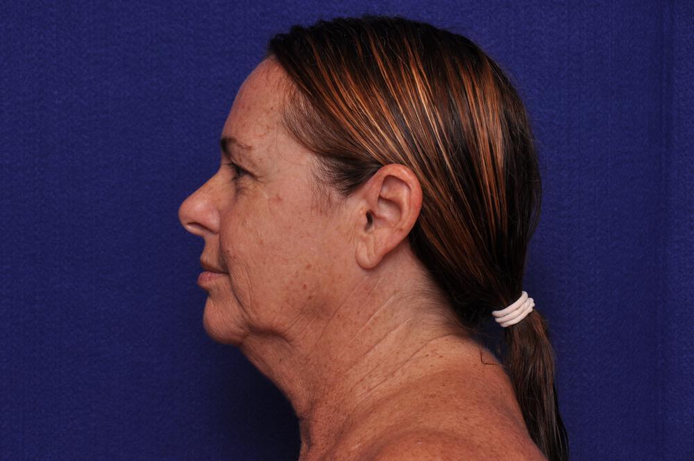 Upper Blepharoplasty Gallery Before & After Image