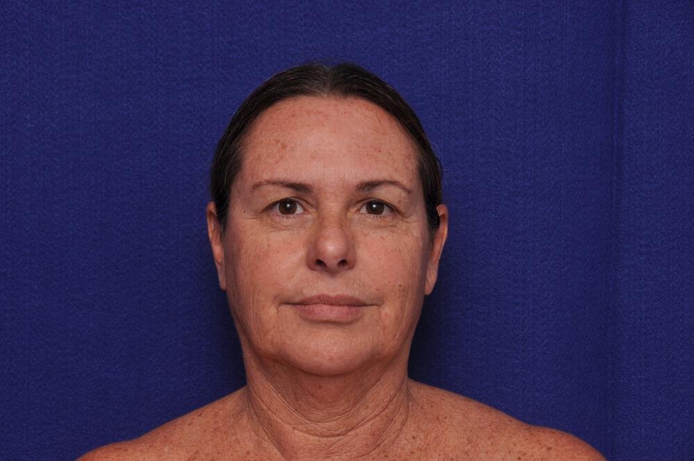 Upper Blepharoplasty Gallery Before & After Image