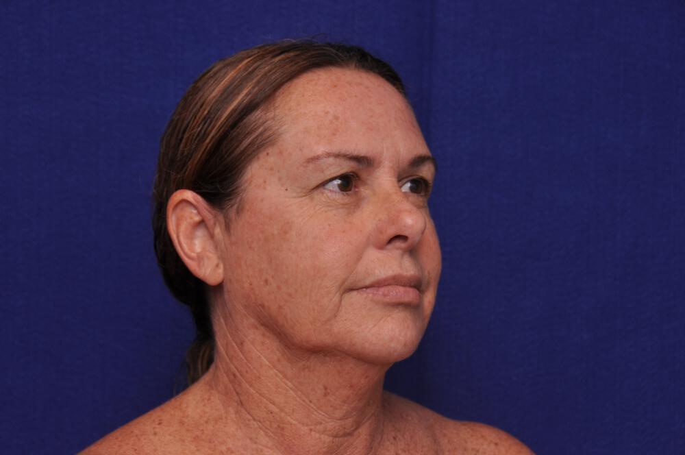 Upper Blepharoplasty Gallery Before & After Image