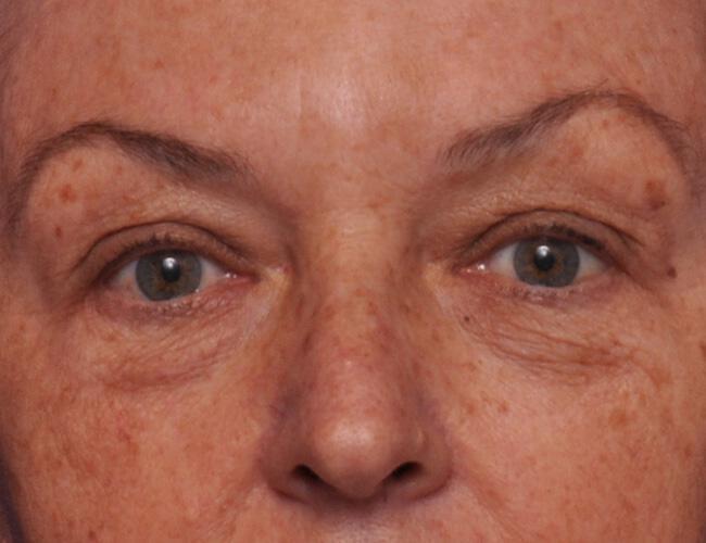 Upper Blepharoplasty Gallery Before & After Image