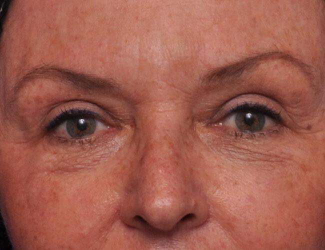 Upper Blepharoplasty Gallery Before & After Image